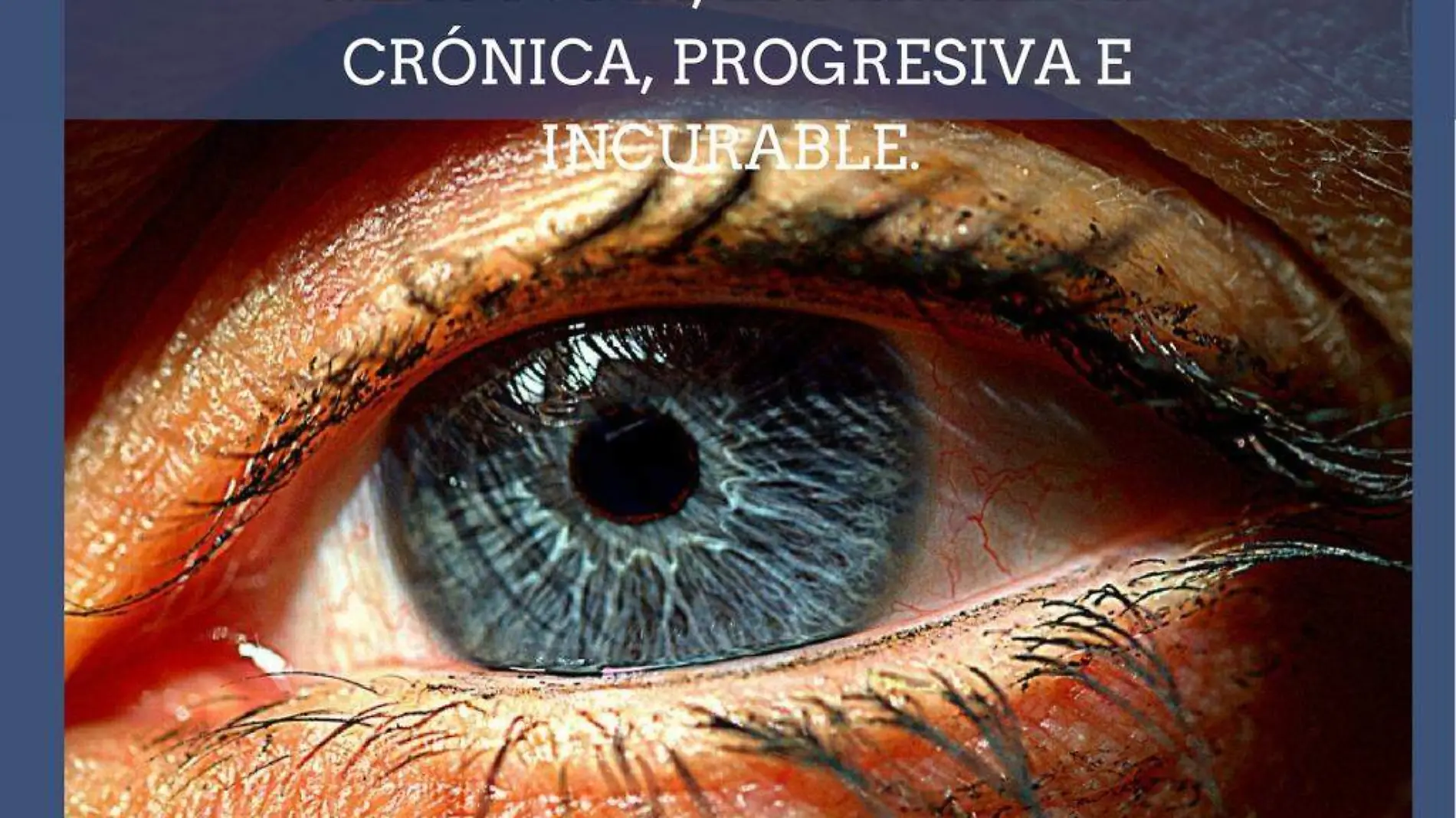 Glaucoma enfermedad crónica progresiva e incurable